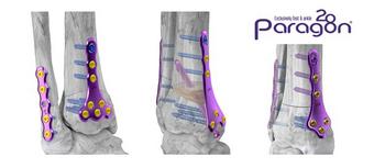 Paragon 28 Launches Comprehensive Supramalleolar Osteotomy System: https://mms.businesswire.com/media/20230523005148/en/1799775/5/Gorillo_SMO_Plating_System.jpg