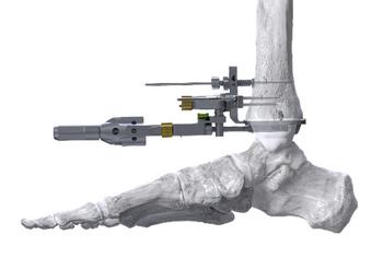 Paragon 28 Introduces a Novel Right-Angle Drill for the APEX 3D™ Total Ankle Replacement System: https://mms.businesswire.com/media/20240910193295/en/2238121/5/Picture2.jpg