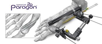 Paragon 28 Launches PRECISION® MIS Bunion System Offering Surgeons a Guided Minimally Invasive Surgical Solution for Treating Patients with Bunions: https://mms.businesswire.com/media/20240201226008/en/2017221/5/Picture1.jpg